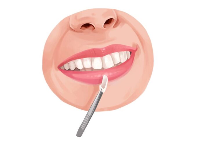 Technical graphic illustration of a dental veneer.