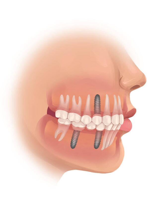 dental implants, tooth replacement, dentures